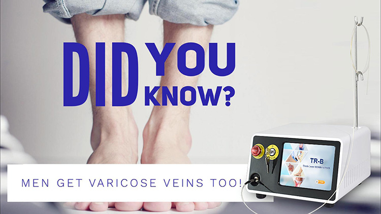 varicose romoval