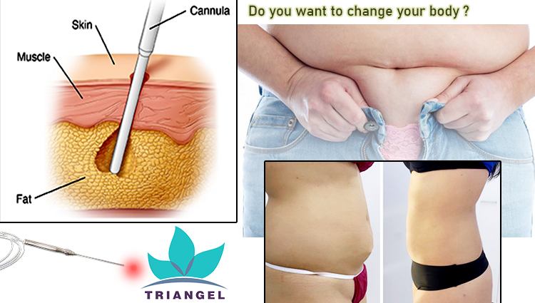 Laser Lipolysis Machine