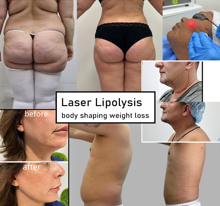 Laser Lipolysis Machine