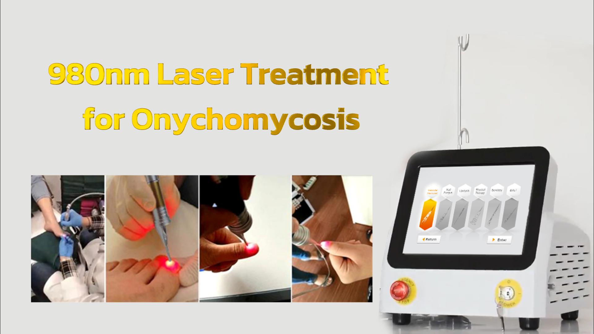 nail fungus removal machine laser