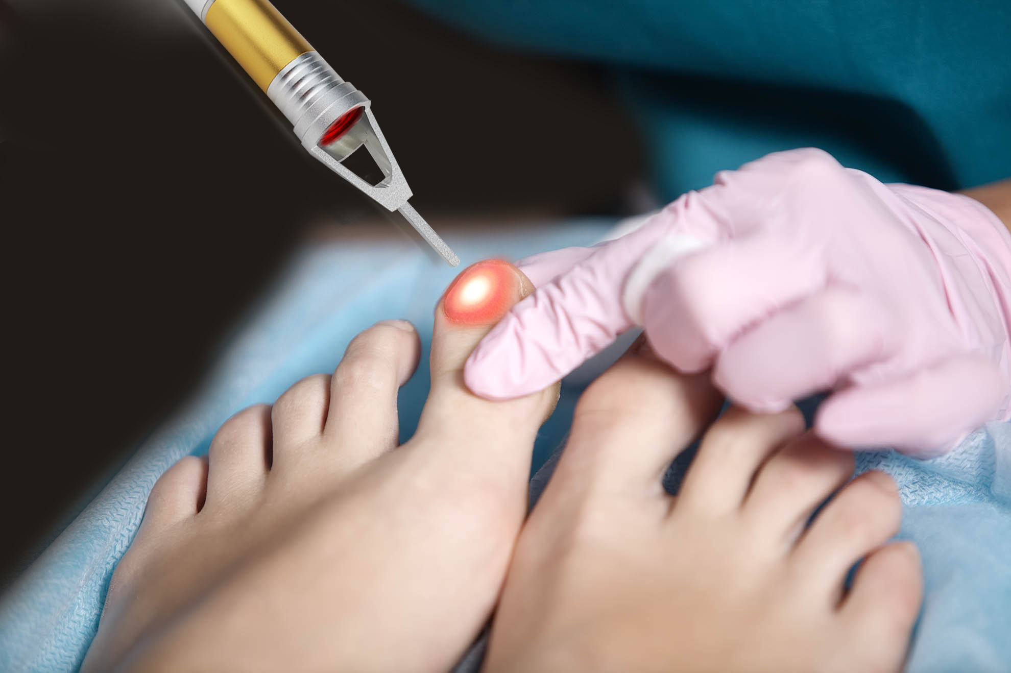 nail fungus removal machine laser