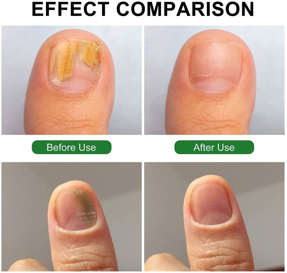 nail fungus removal machine laser
