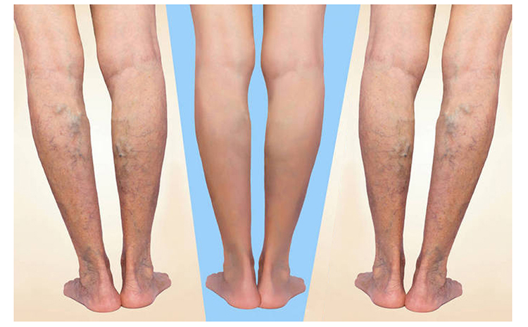 varicous veins