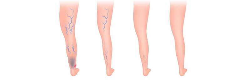varicous veins