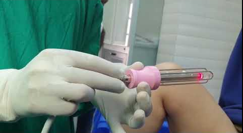 gynecological machine laser