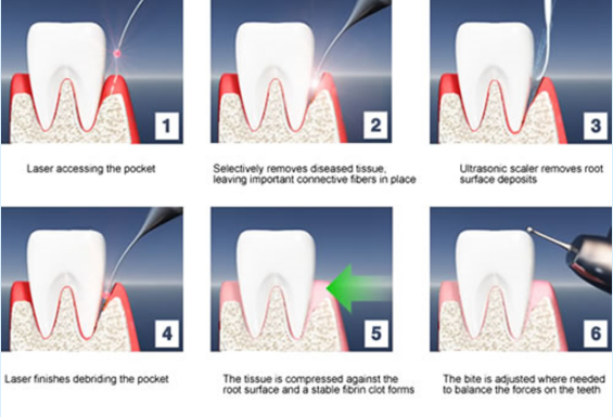 laser dental teeth whitening
