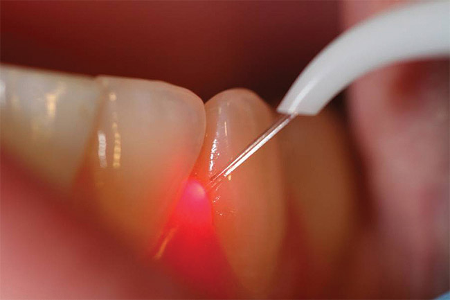 laser dental teeth whitening