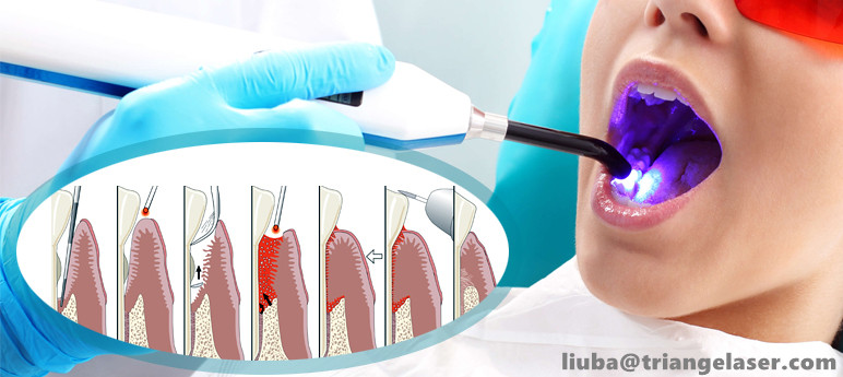 laser dental teeth whitening