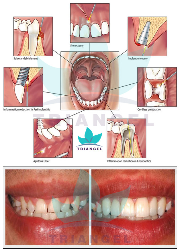 laser dental teeth whitening