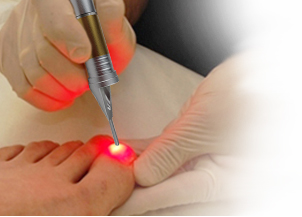 nail fungus laser treatment device