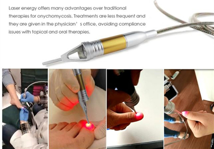 nail fungus laser treatment device