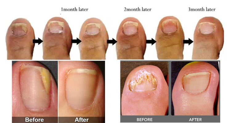 nail fungus laser treatment device