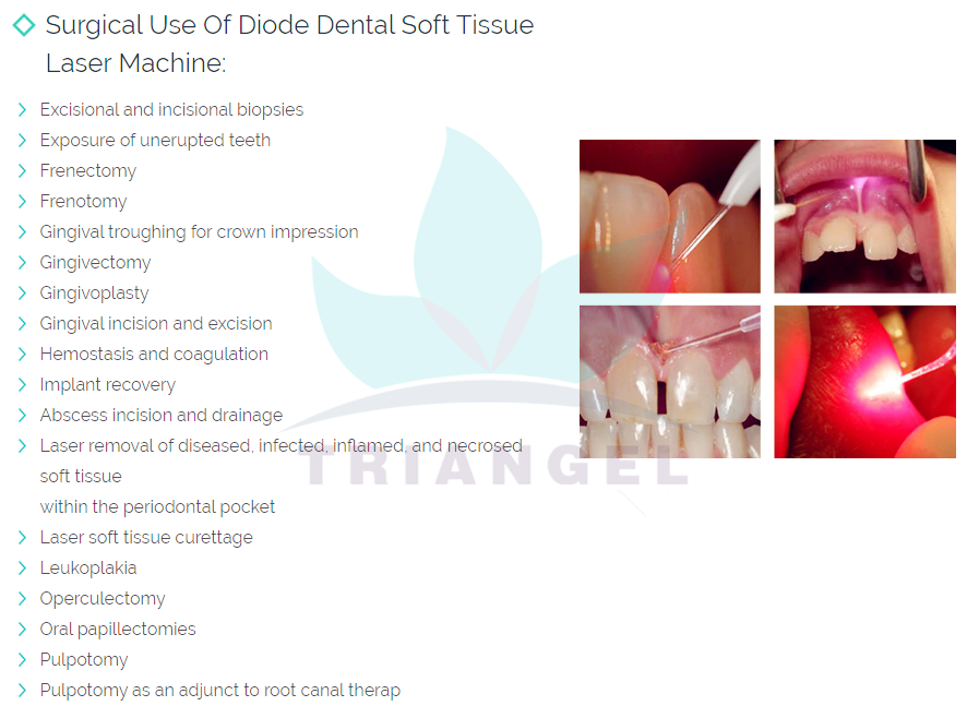 980nm diode for dentistry Triangel RSD