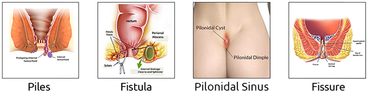 laser diodo para fistulas