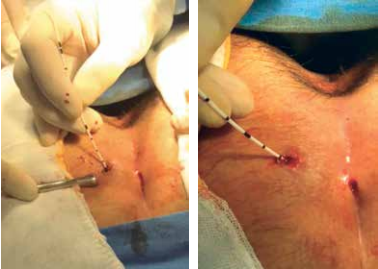 laser diodo para fistulas
