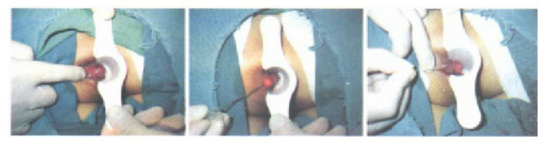 laser diodo para fistulas