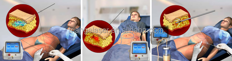 liposuction machine