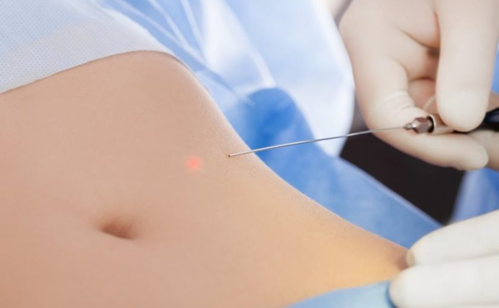 liposuction machine