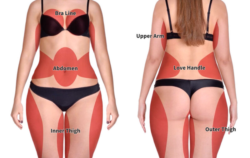 liposuction machine