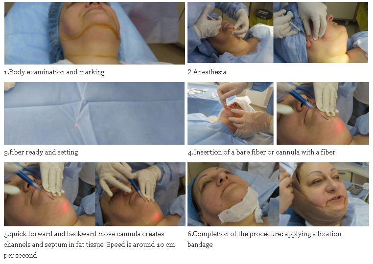 liposuction machine
