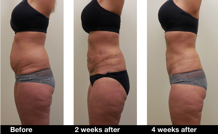 liposuction machine
