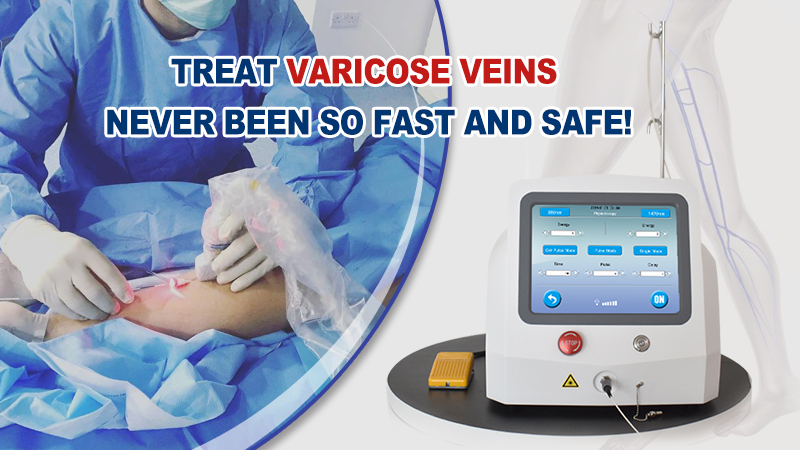 varicose vein treatment