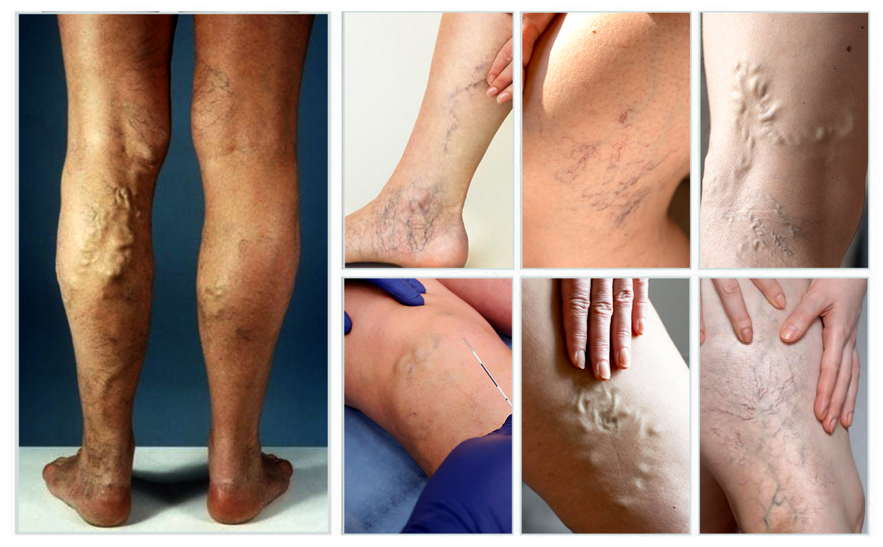 varicose vein treatment