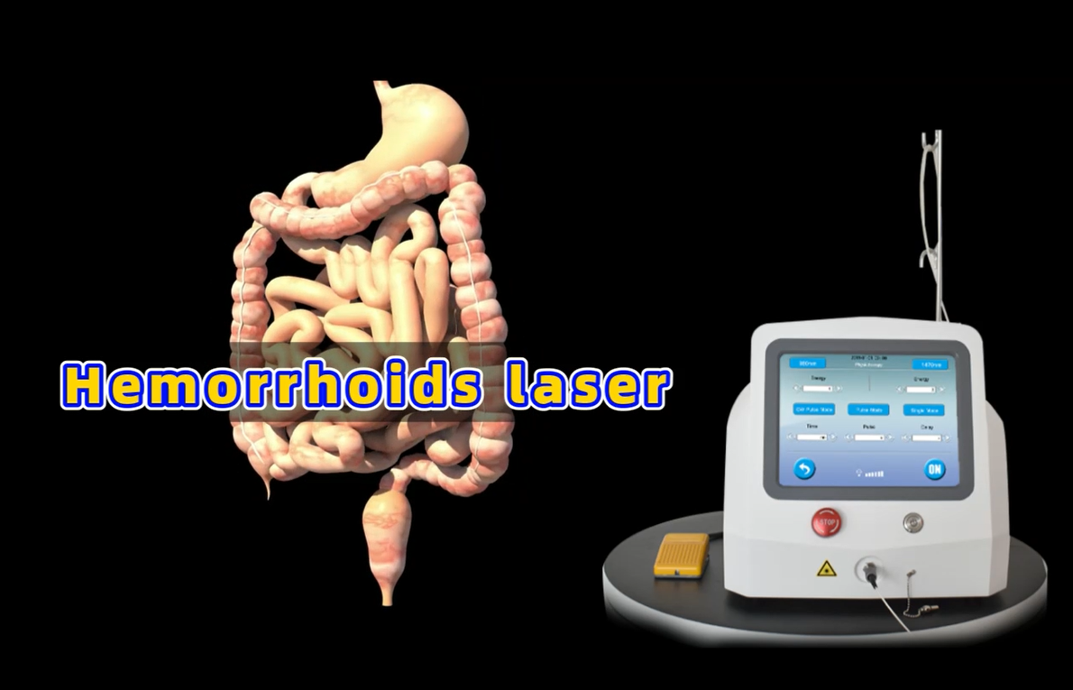 diode laser 980 1470 nm for hemorrhoid anal fistula hemorrhoid