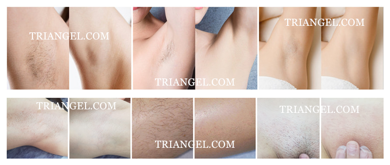 laser hair removal 808 medical diode