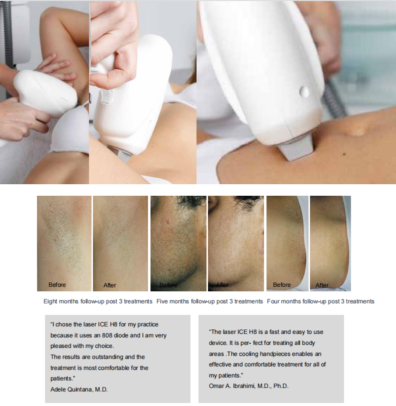 808 diode laser hair removal