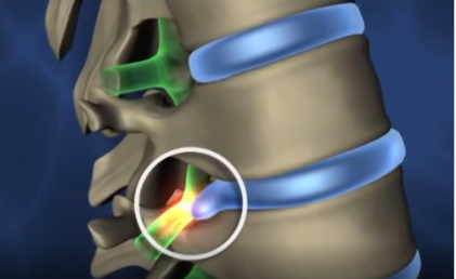 pldd laser device