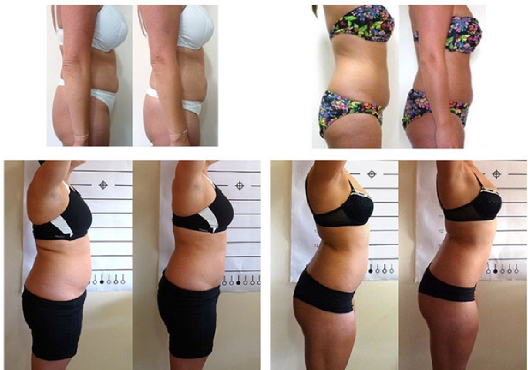5d lipolaser body slimming
