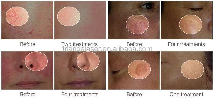 980nm diode laser spider vein covera vascular laser