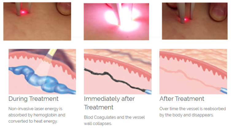 980nm diode laser spider vein covera vascular laser