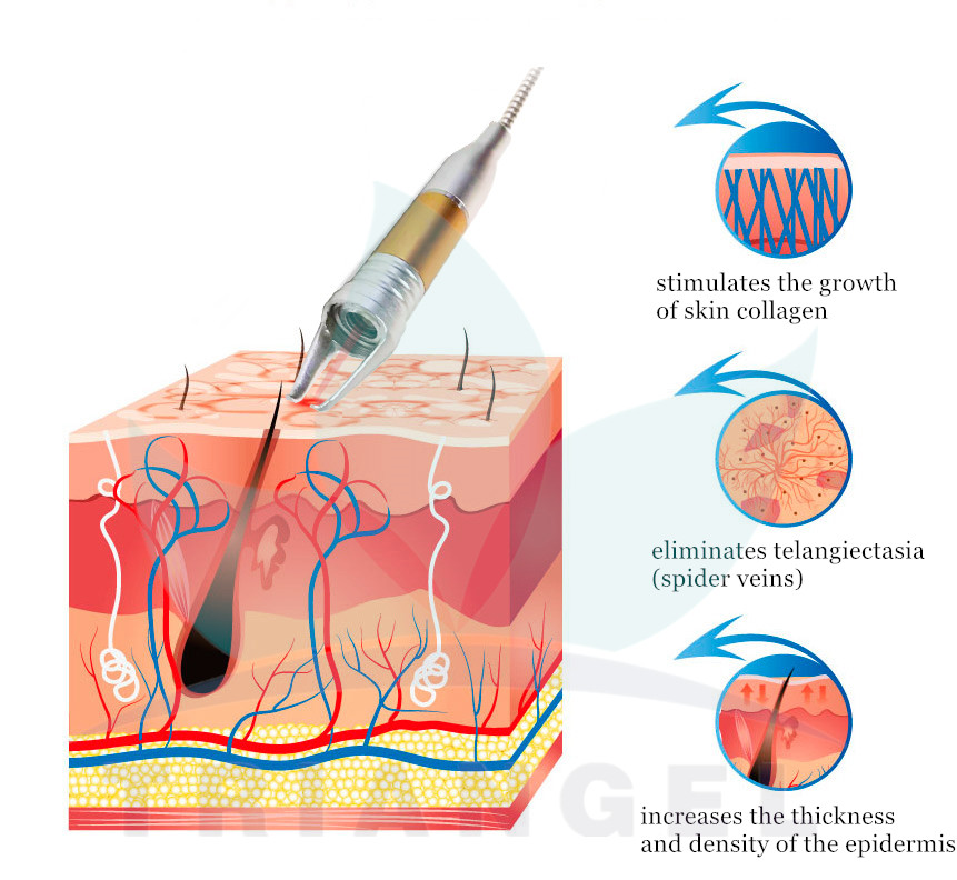 spider vein removal machine