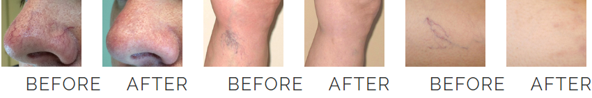spider vein removal machine