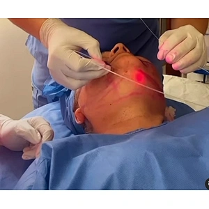 2024 Newest Endolaser 1470nm 980nm Diode Laser Face Lifting Liposuction Machine