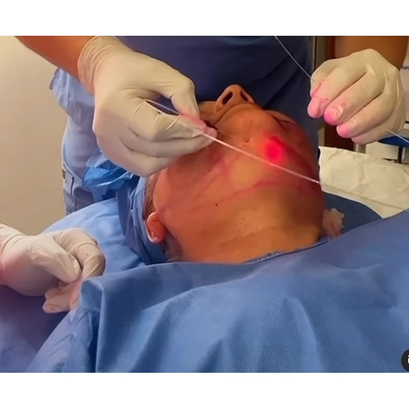 2024 Newest Endolaser 1470nm 980nm Diode Laser Face Lifting Liposuction Machine