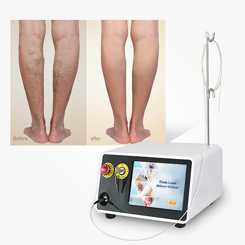 Endovascular Vein Fiber Varicose Veins Laser 980nm 1940nm 1470nm Machine