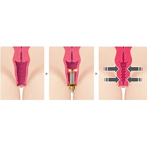 Non Surgical Portable Vaginal Rejuvenation Diode 980 Nm 1470 Nm Cosmetic Gynecology Laser Device Vaginal Tightening  Laser