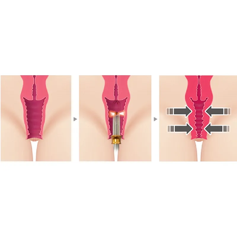 Non Surgical Portable Vaginal Rejuvenation Diode 980 Nm 1470 Nm Cosmetic Gynecology Laser Device Vaginal Tightening  Laser