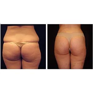 Laser 1470 nm Surgical Liposuction  Face  Laser Lipolysis Machine