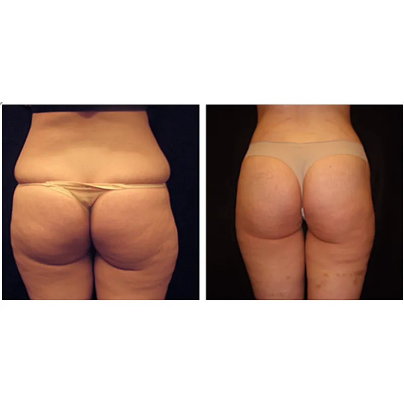 Laser 1470 nm Surgical Liposuction  Face  Laser Lipolysis Machine