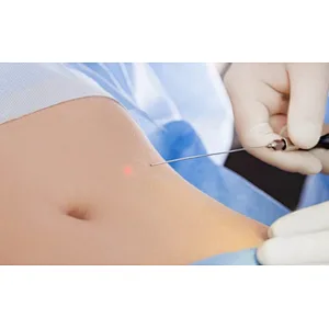 Factory Supply Best Quality Liposuction Lipolysis Endolaser Fat Reduction Skin Rejuvenation Face Lifting Laser 1470nm
