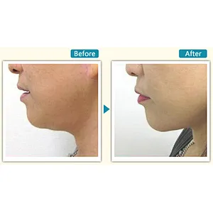 Portable 980nm 1470nm 30W 60W Facial Lift Lipolysis Laser Endo Machine