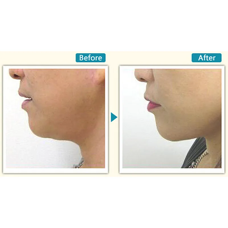 Portable 980nm 1470nm 30W 60W Facial Lift Lipolysis Laser Endo Machine