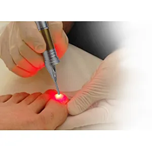 Hot Sale Class IV Diode Lase Treatment Nail Fungus Treatment Onychomycosi Toe Device