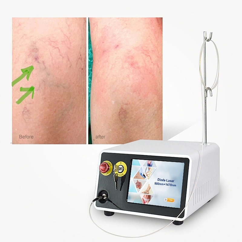 High Power Diode Laser 980nm 1470nm Surgical Varicose Veins EVLT Minimally Invasive Laser Device