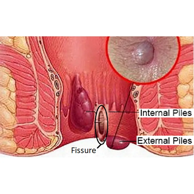 Anal Fistula Hemorrhoids Diode Laser 1940nm 1470nm 980nm Hemorrhoids Treatment Machine