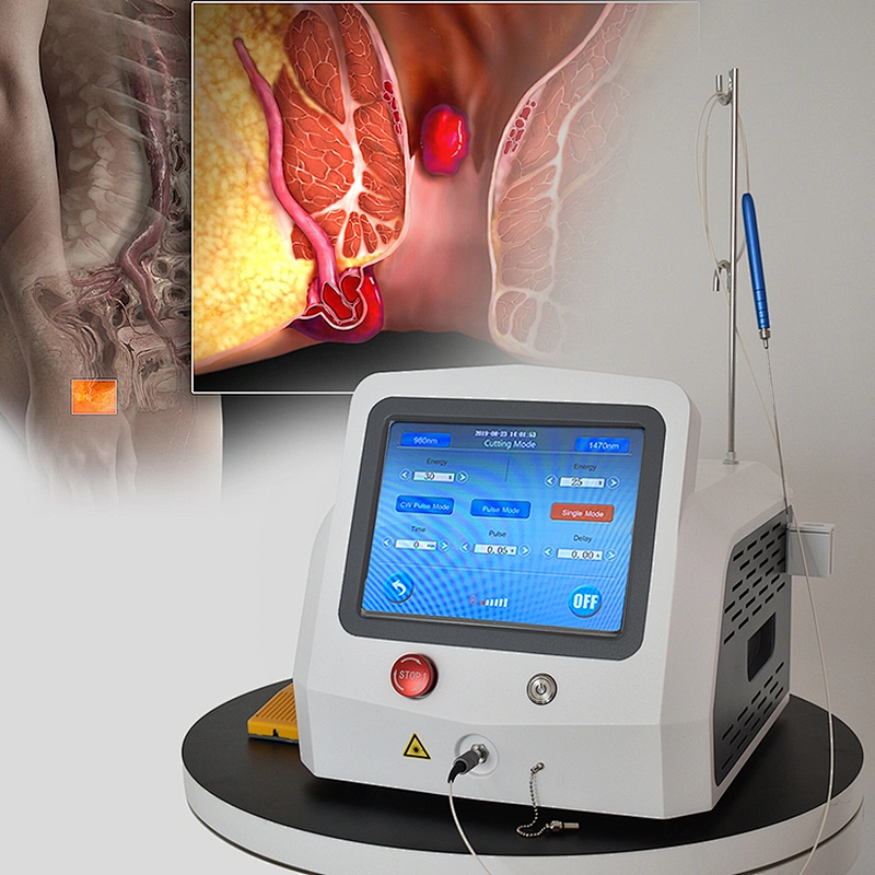 Proctological Surgery 980nm 1470nm Laser Machine Hemorrhoids  Laser Treatment  Diode Laser Machine